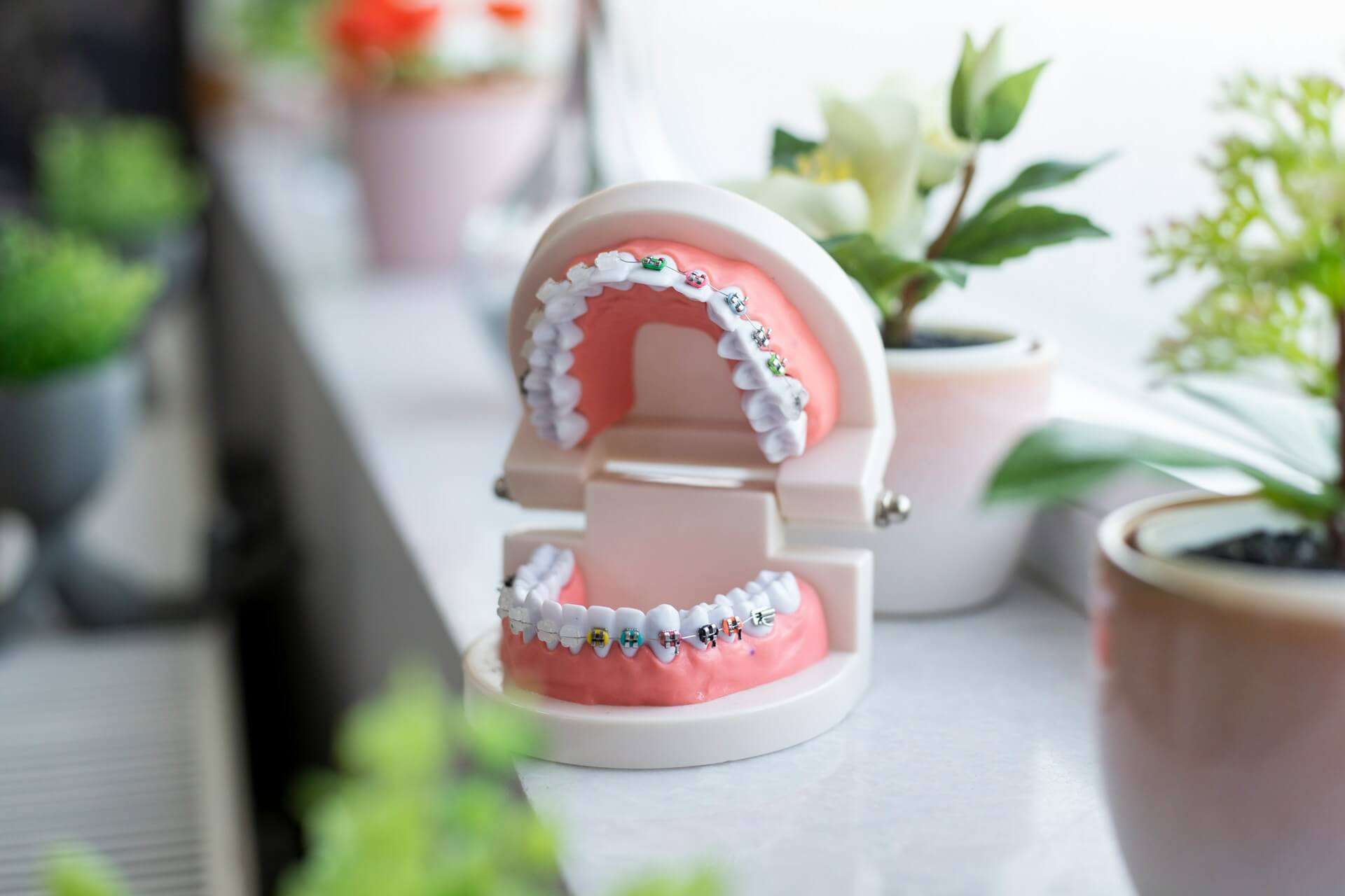 Ortodoncija AM Dental - fiksni aparatić