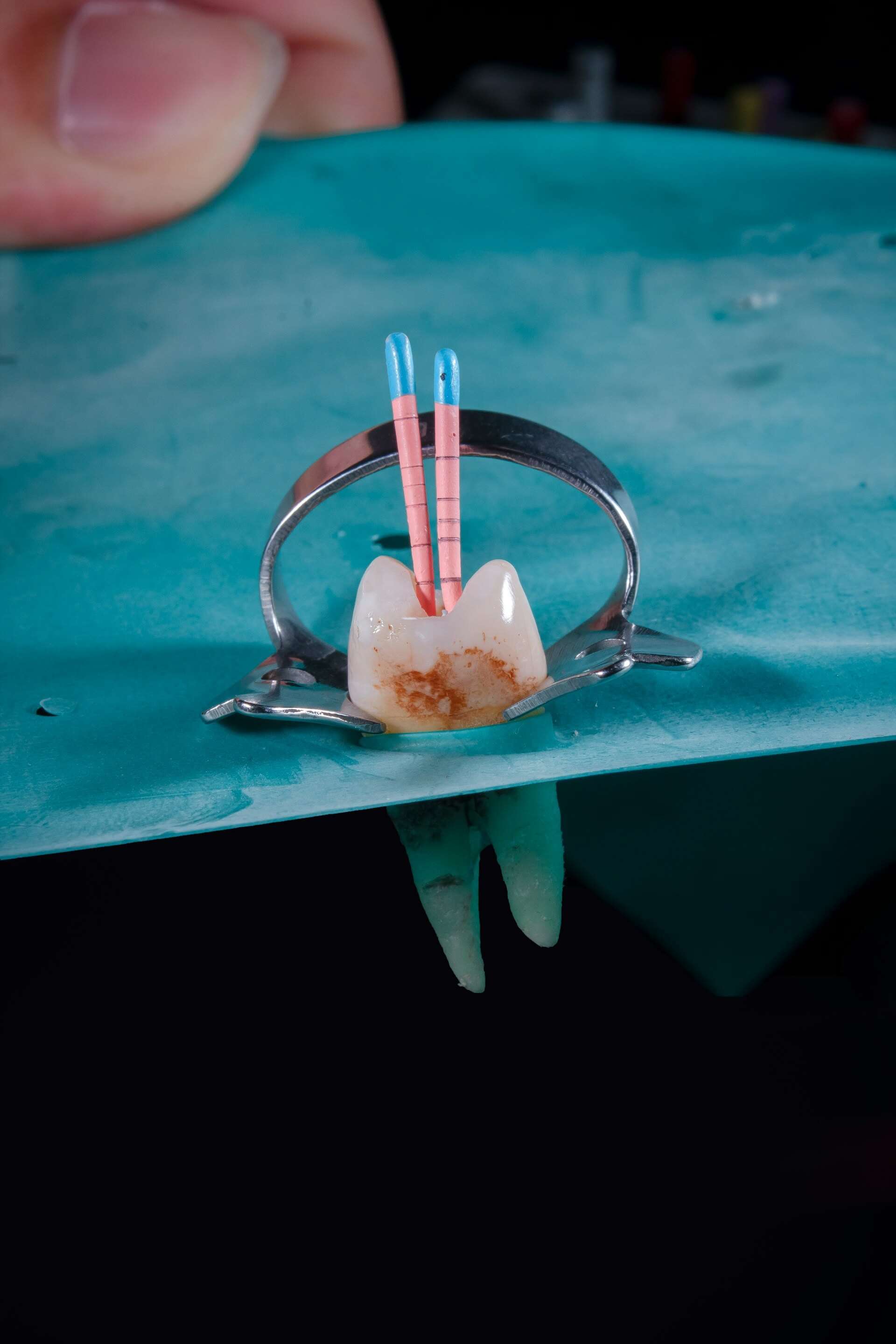 Lečenje kanala korena AM Dental - ordinacija